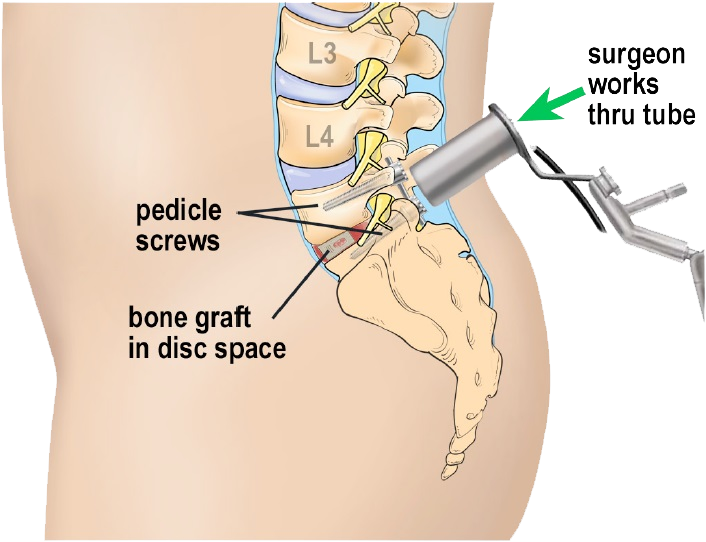 Minimally Invasive Spine Surgery Boca Raton Spine Center