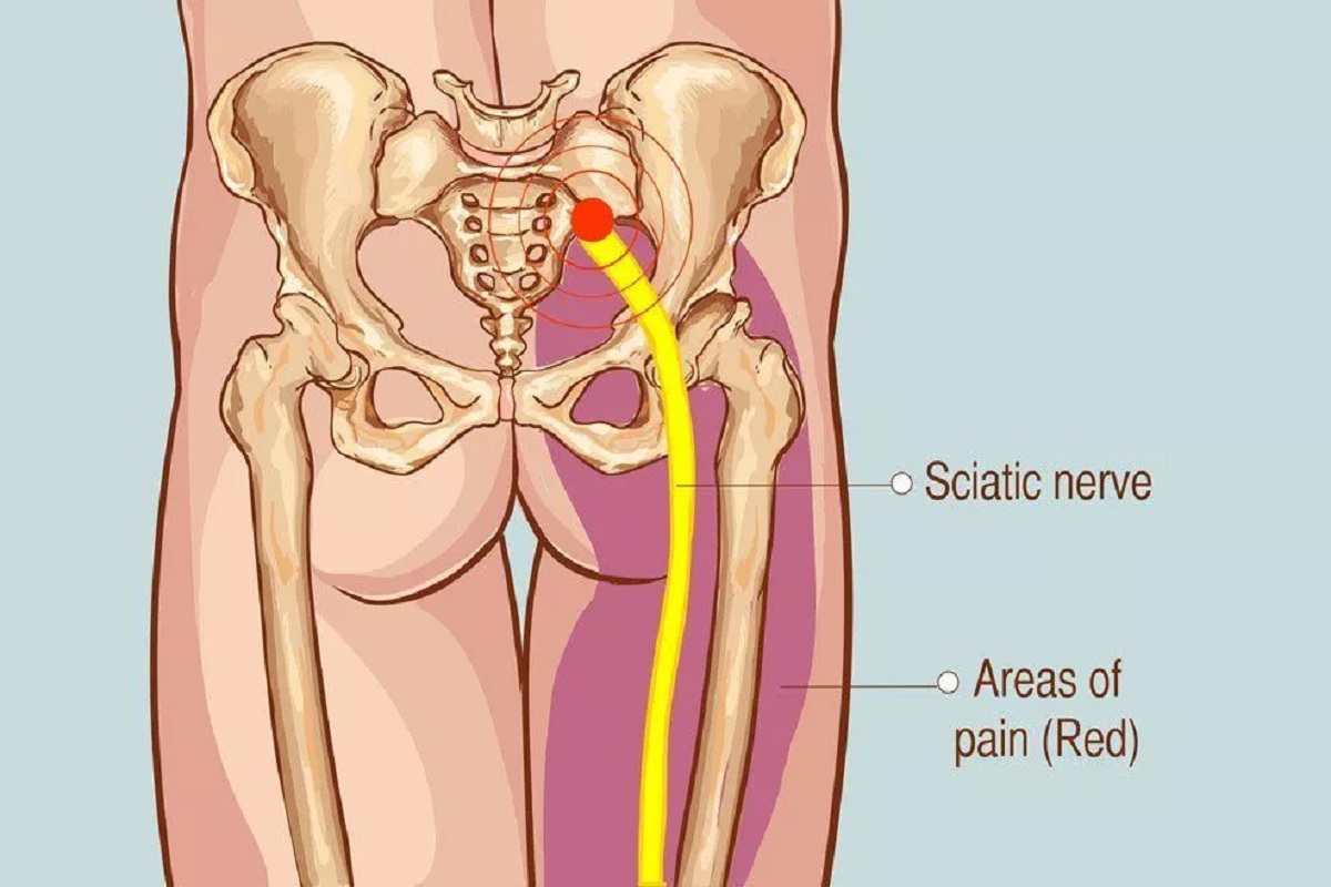 Sciatica: What a Pain in the Buttocks! - Physiovive